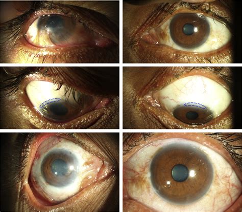 Unilateral Partial Limbal Stem Cell Deficiency Contralateral Versus