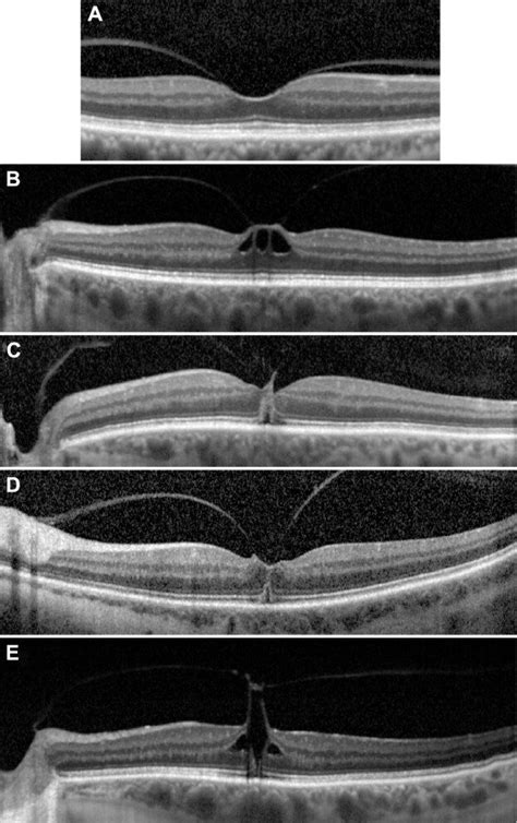 Macular Hole Stages