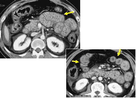 Learningradiology Acute Abdominal Emergencies