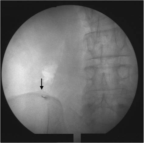 Evaluation Of The Efficacy Of Superior Cluneal Nerve Block In Low Back