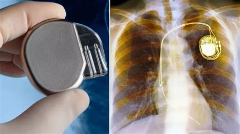 Scientists Develop Battery Free Pacemaker Powered By Energy From Heartbeats Mirror Online