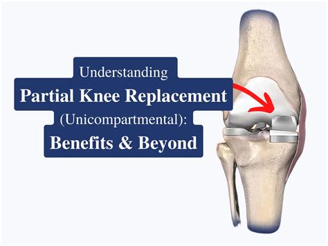 What Is Partial Knee Replacement Unicompartmental