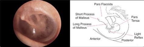 Normal Tympanic Membrane Landmarks