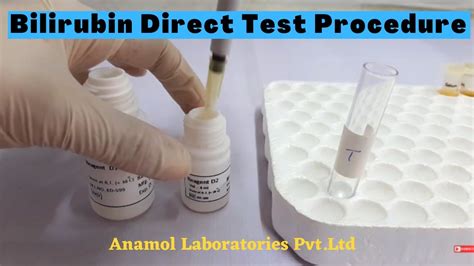 Bilirubin Test Procedure Bilirubin Direct Test Procedure In English