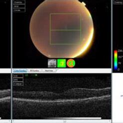 Oct Scan Of One Of The Cases In The Silicone Oil Group Preoperative