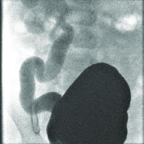 Dilated tortuous ureter with grade V vesicoureteral reflux. | Download ...