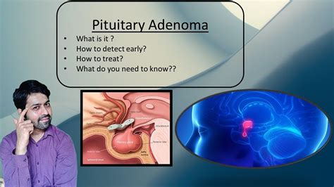 Pituitary Adenoma Early Symptoms Diagnosis And Treatment