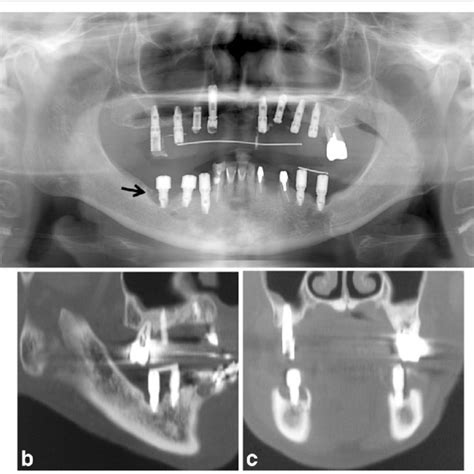 A Panoramic Radiograph Showing The Sequestrum Separation After 5 Months