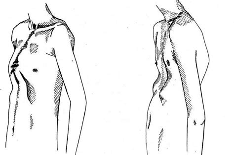 4 Chest deformity: Pigeon chest and funnel chest deformity | Download ...