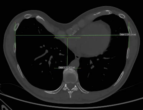 La Correction Du Pectus Excavatum Paris Dr Gorj