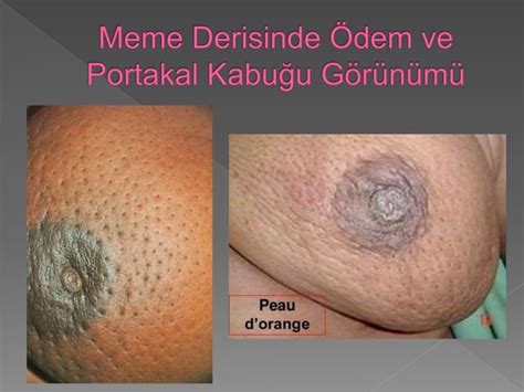 Meme Kanseri Ve Kendi Kendine Meme Muayenesi Egitimi Ppt