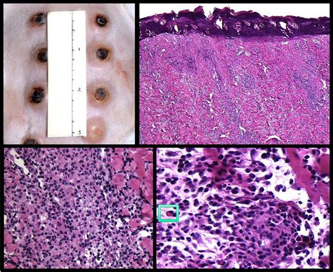 Primary Syphilis Histology