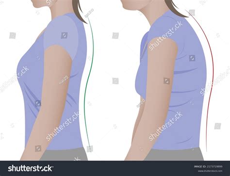 Spine Deformation Types Healthy Spine Comparison Stock Vector Royalty Free 2173719899