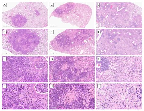 Tuberculosis Lungs Histology