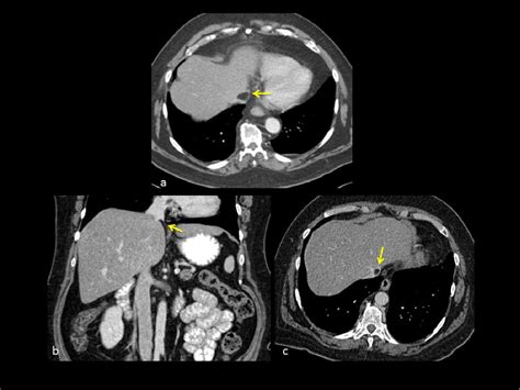 Figure 22 From Mri Techniques In Diagnosis Of Non Neoplastic Fat