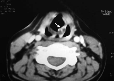 Anteromedial location and thickening of the left aryepiglottic fold in ...