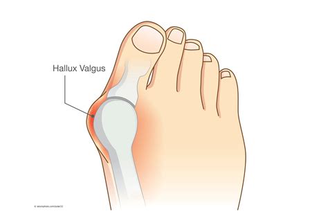 Hallux Valgus