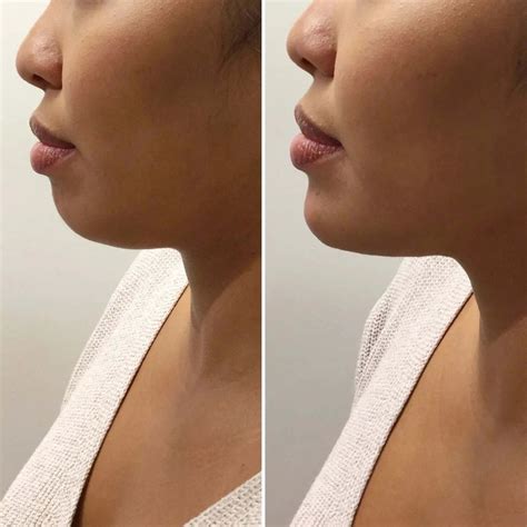 Chinfix Filler Beautyfix Medspa 212 366 4787