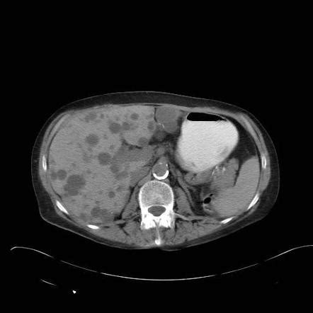 Focal Hypodense Hepatic Lesions On Non Enhanced Ct Differential