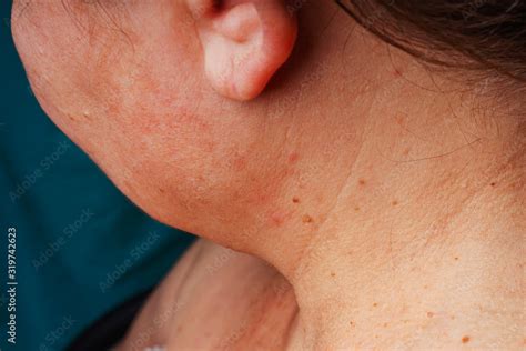 Age Spots Moles And Freckles On The Neck Spots On The Body Middle