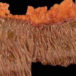 A Gross Photograph Of Hyperplastic Polyposis A Segment Of Right Colon