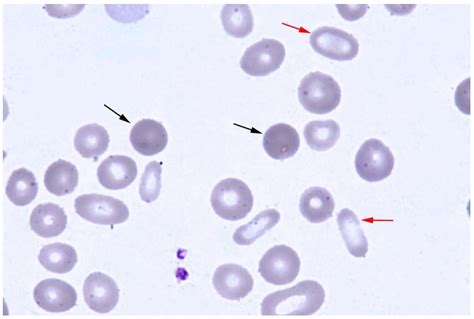 Sideroblastic Anemia Peripheral Smear