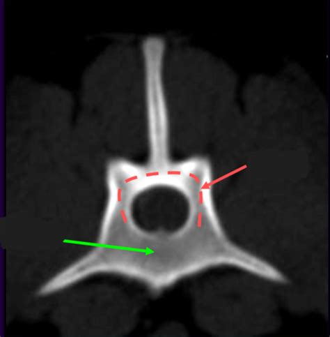 Anatomy Radiology Of The Spine Flashcards Quizlet