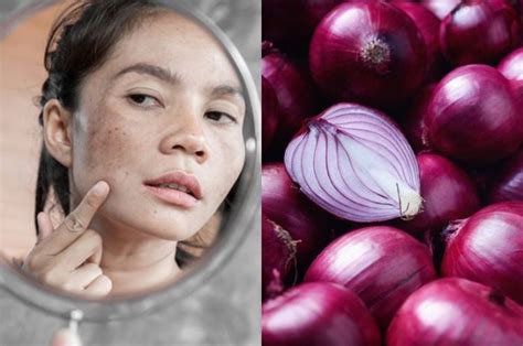 Tak Perlu Skincare Mahal Begini Cara Mudah Menghilangkan Flek Hitam Di