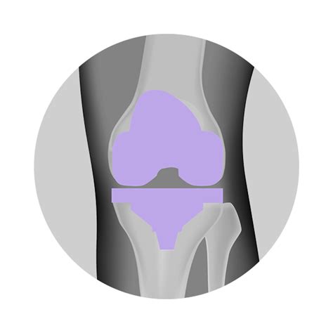 Types Of Knee Surgeries — Unova Ambulatory Surgery Center