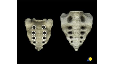 Pelvis Sacral Fracture Reduction And Fixation With Iliosacral