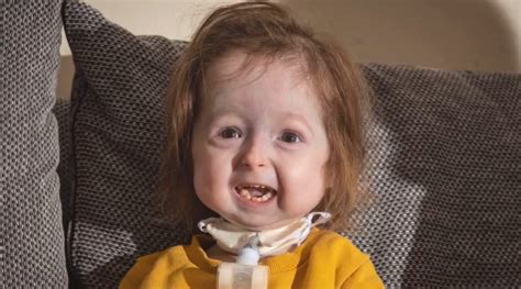 Progeria Syndrome Uk Girl Is The Only Person In The World To Have A