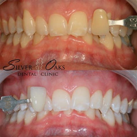 Teeth Whitening Myths Debunked Silver Oaks Dental Clinic