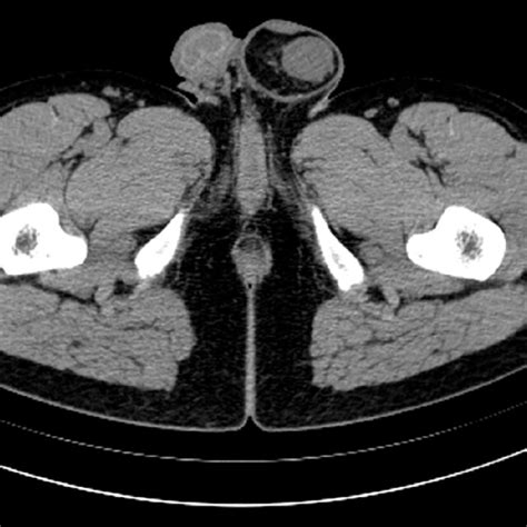 Pelvic Computed Tomography Findings Pelvic Computed Tomography Showed