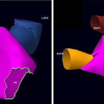 Activation Map Of The Left Atrium During Sinus Rhythm Before Left