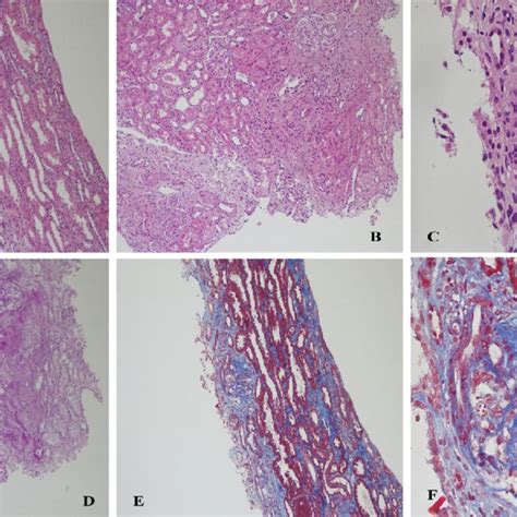 Light Microscopic Findings With Hematoxylin And Eosin Stain Focal