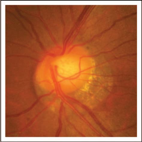 Figure From The Pathophysiological Significance Of Optic Nerve Head