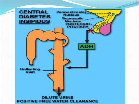 Diabetes Insipidus Ppt