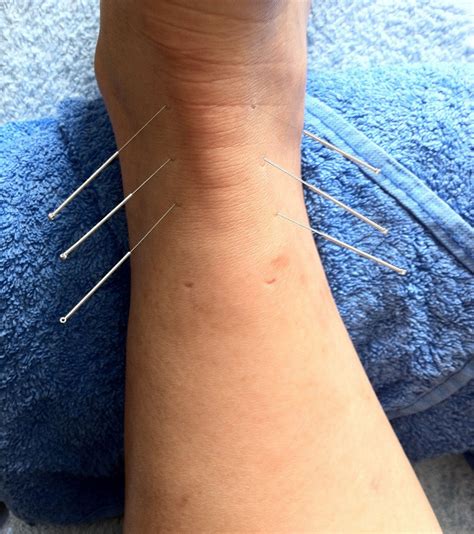 Dry Needling Acupuncture The Physio Company Glasgow