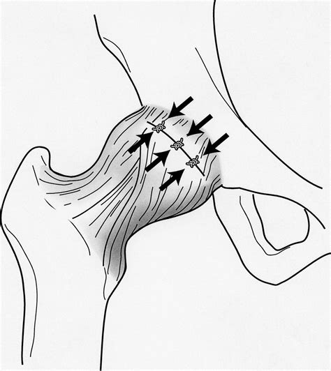 Arthroscopic Capsulotomy Capsular Repair And Capsular Plication Of