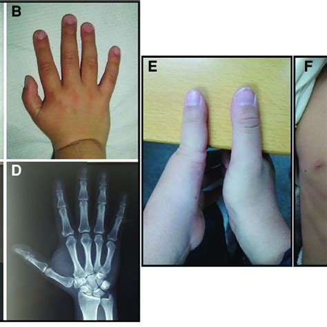 Photographs Of The Proband Showing A Mildly Hypoplastic Left Thumb