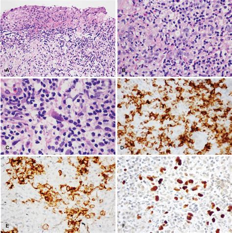 Histopathologic Features And Immunophenotypic Profile Of Epsteinbarr