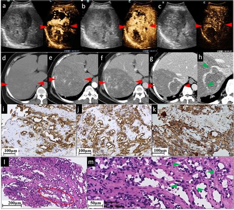 Frontiers Case Report The Value Of Contrast Enhanced Ultrasound And