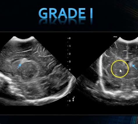 Neonatal Brain Ultrasound Ivh And Pvl Part 2 Education 99nicu