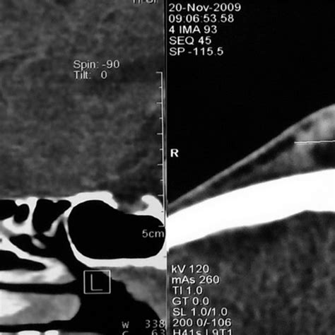 Sagittal A And Axial B Contrast Enhanced Ct Scan Of The Paranasal