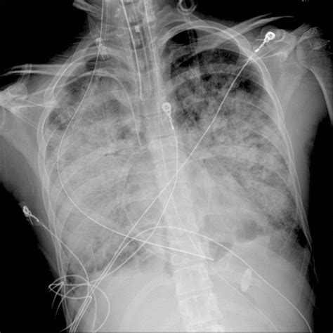 Radiologic Pathologic Clinical And Physiologic Findings Of