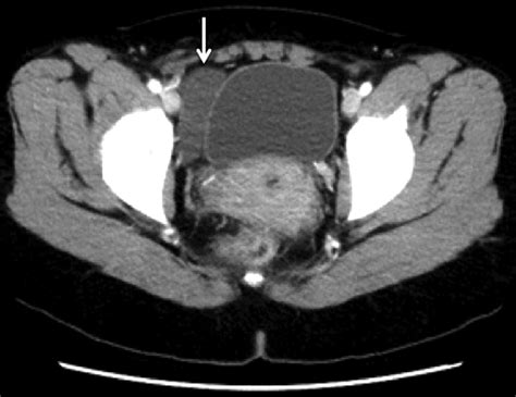 An Axial Image From The Ct Scan Demonstrating A Fluid Collection In The Download Scientific