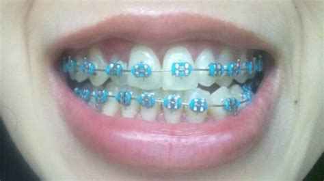 baby blue braces colors - Wyatt Dunaway