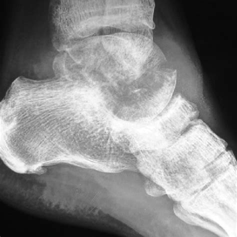 X Ray Left Foot And Ankle Image Showing Lytic Lesion In The Talus With Download Scientific