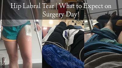 Fai Hip Labral Tear What To Expect On Surgery Day Hip Surgery