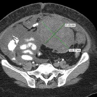 Showing A Large Well Defined Intra Abdominal Mass Measuring X